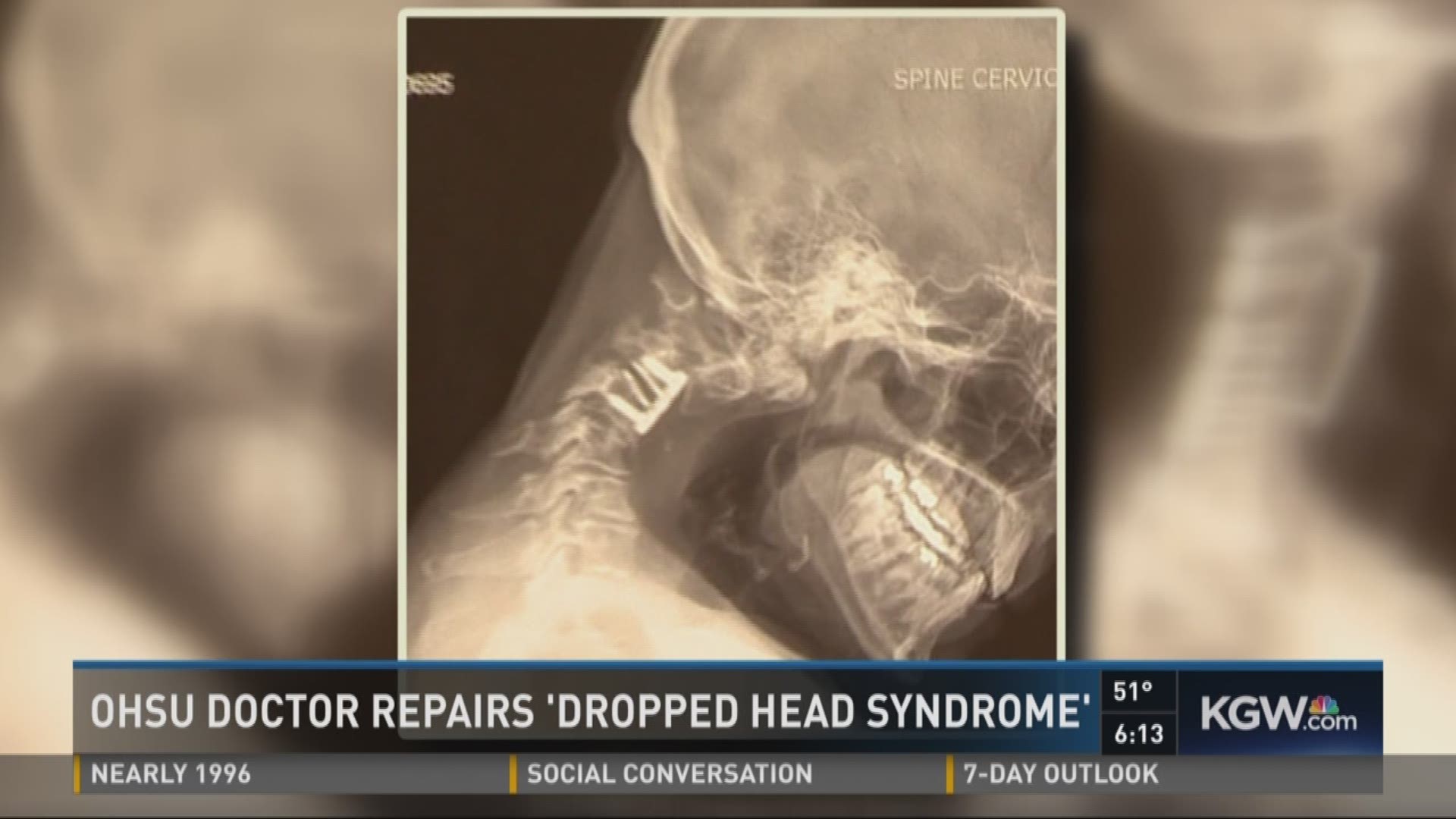 OHSU doctor repairs 'dropped head syndrome'