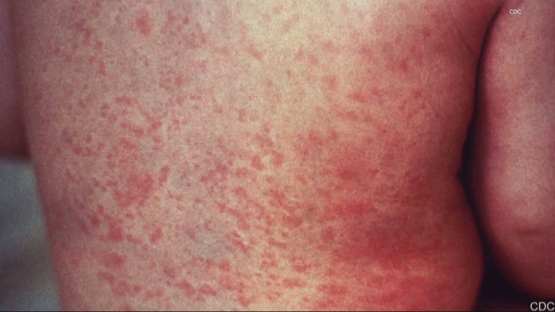 The epicenter of the measles outbreak is believed to be in Clackamas and Marion County. Oregon has had 14 measles cases in recent months — the most since 2019.