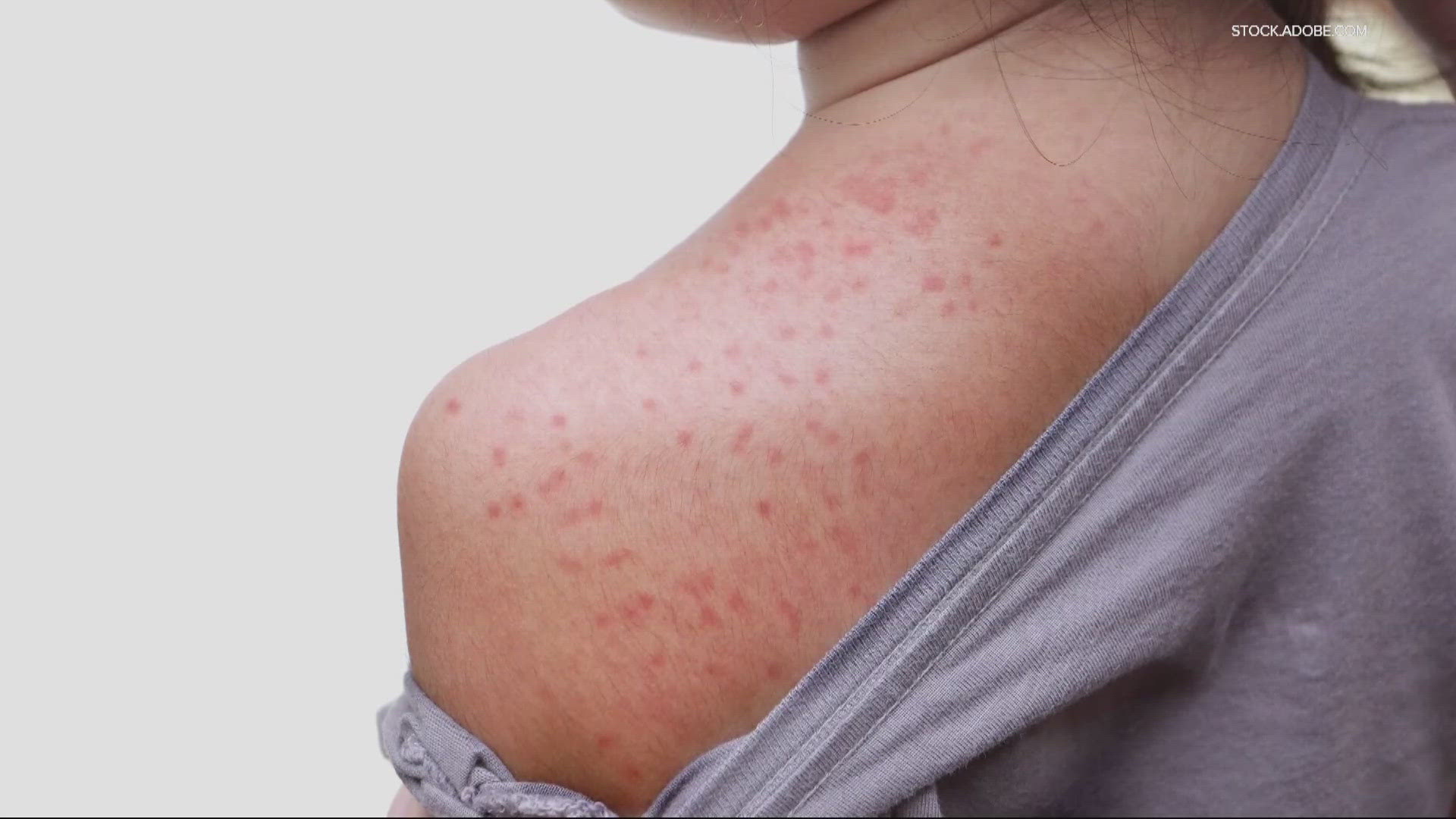 The largest measles outbreak in Oregon in three decades has doctors issuing a waring to parents to get vaccinated.