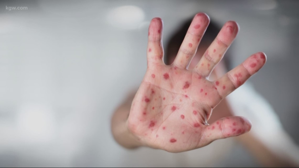 Two new measles cases linked to PDX exposure - KGW.com thumbnail