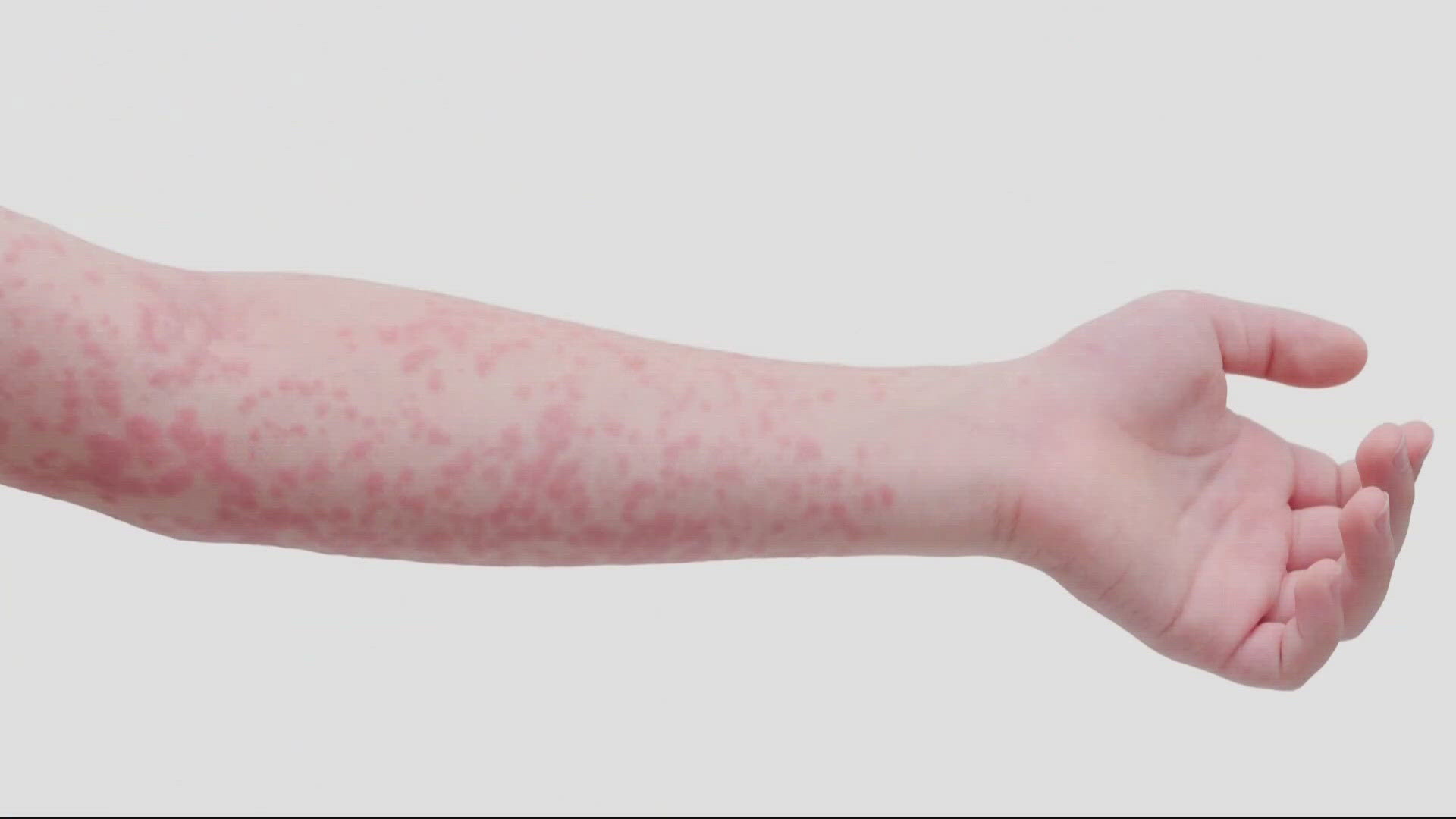 The Oregon Health Authority said that an adult was hospitalized with measles symptoms June 19. A lab confirmed the disease a few days later.