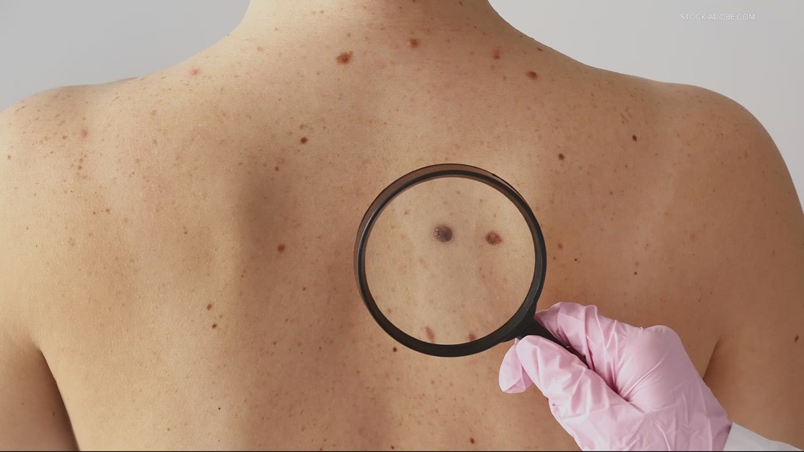 OHSU dermatologists set new record for finding smallest skin cancer