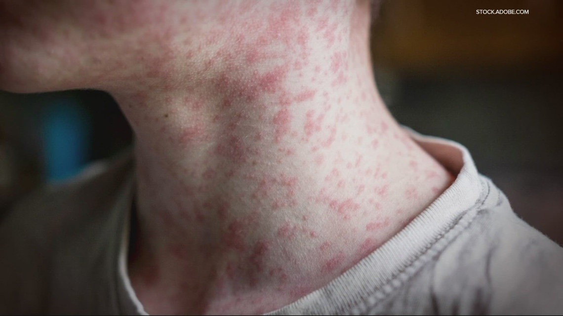 Officials confirm another measles exposure site in Oregon City as disease quickly spreads across US