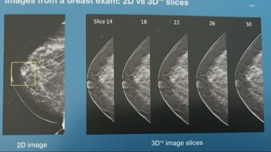 Nationwide push fixated on earlier mammogram screenings