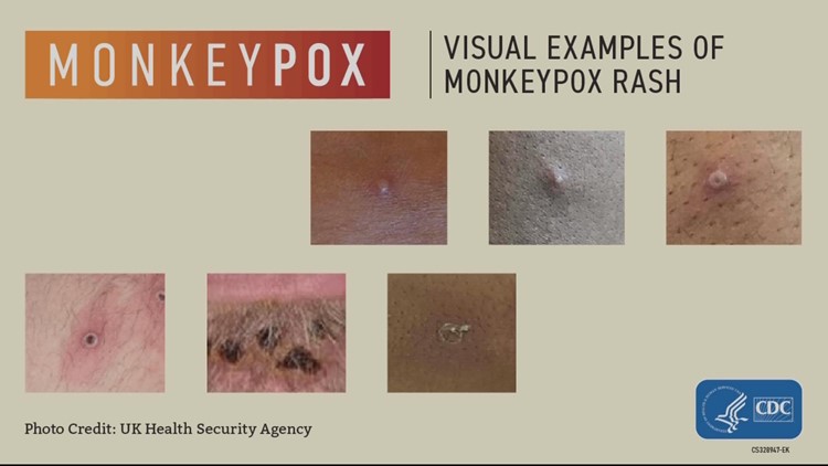 Monkeypox looks like it's going to be around for the long haul