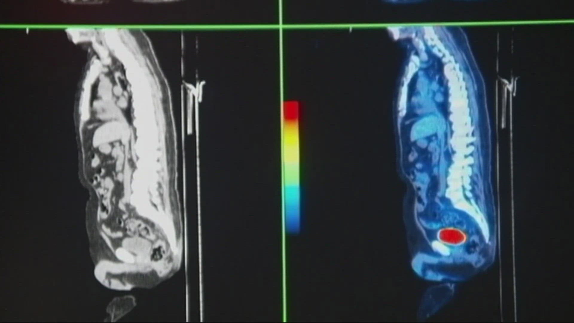 Oregon surgeons began using a non-invasive robotic device to destroy prostate cancer, which is the second leading cause of cancer death for U.S. men.