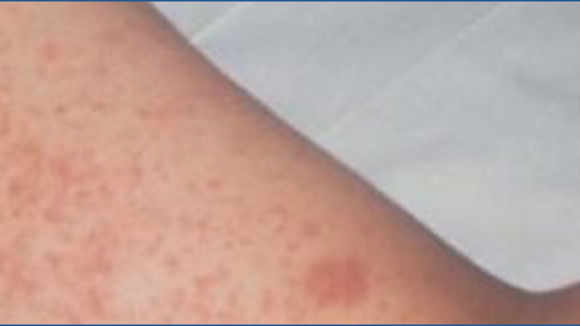 Measles exposure alert at Battle Ground school | kgw.com