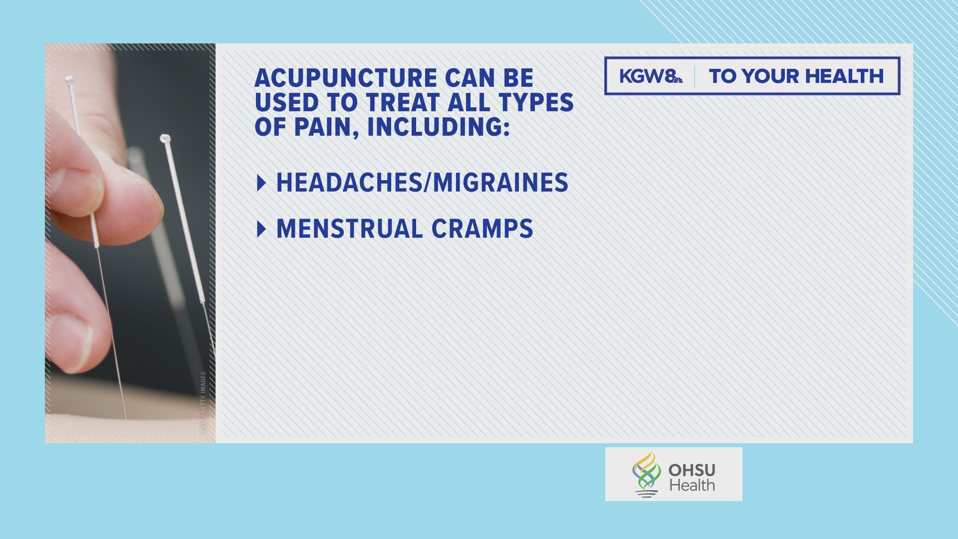 From OHSU Health, here are some types of pain acupuncture can be used to treat.