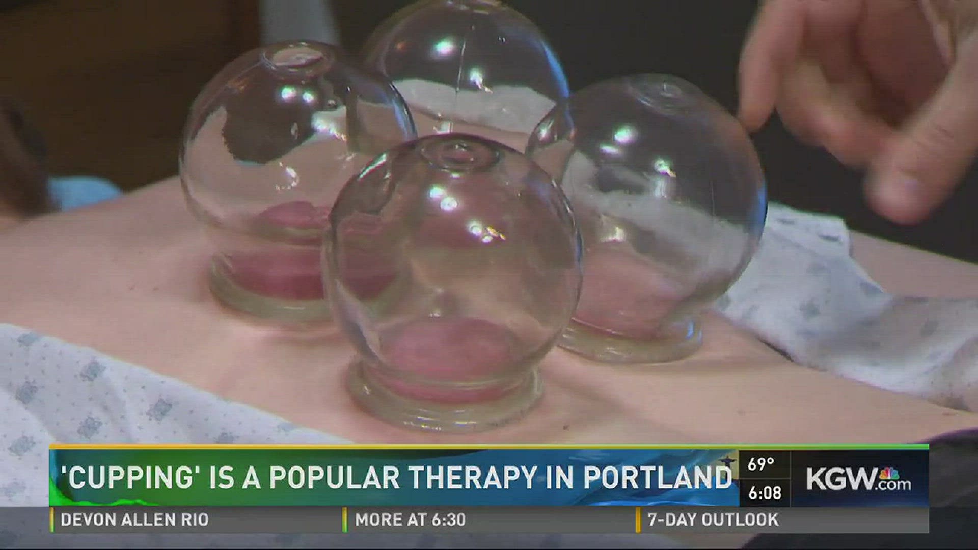 'Cupping' is a popular therapy in Portland | kgw.com