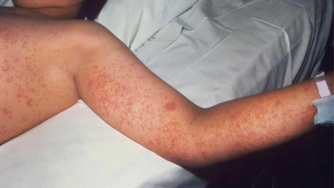 Measles outbreak in Oregon, officials urge vaccination