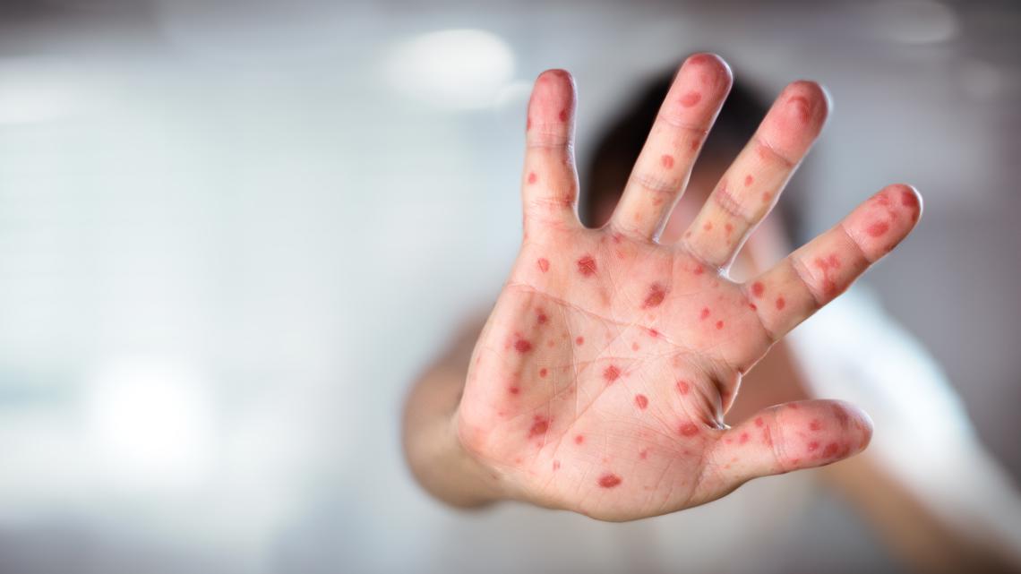 Two Unvaccinated Individuals Contract Measles in Oregon: Potential Exposure Sites Identified