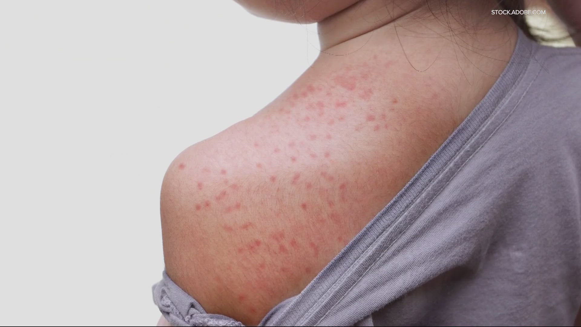 There is currently no connection to all eight measles cases and there is no known public exposure of the disease. The cases involve people who are not vaccinated.