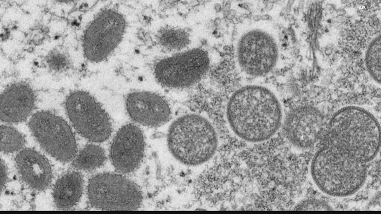 Health officials confirm monkeypox case in Washington state