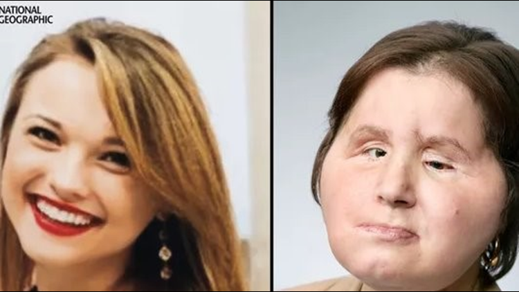 Face transplant recipient at Cleveland Clinic receives second chance after suicide attempt